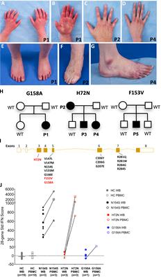 Case Report: Novel SAVI-Causing Variants in <mark class="highlighted">STING1</mark> Expand the Clinical Disease Spectrum and Suggest a Refined Model of STING Activation